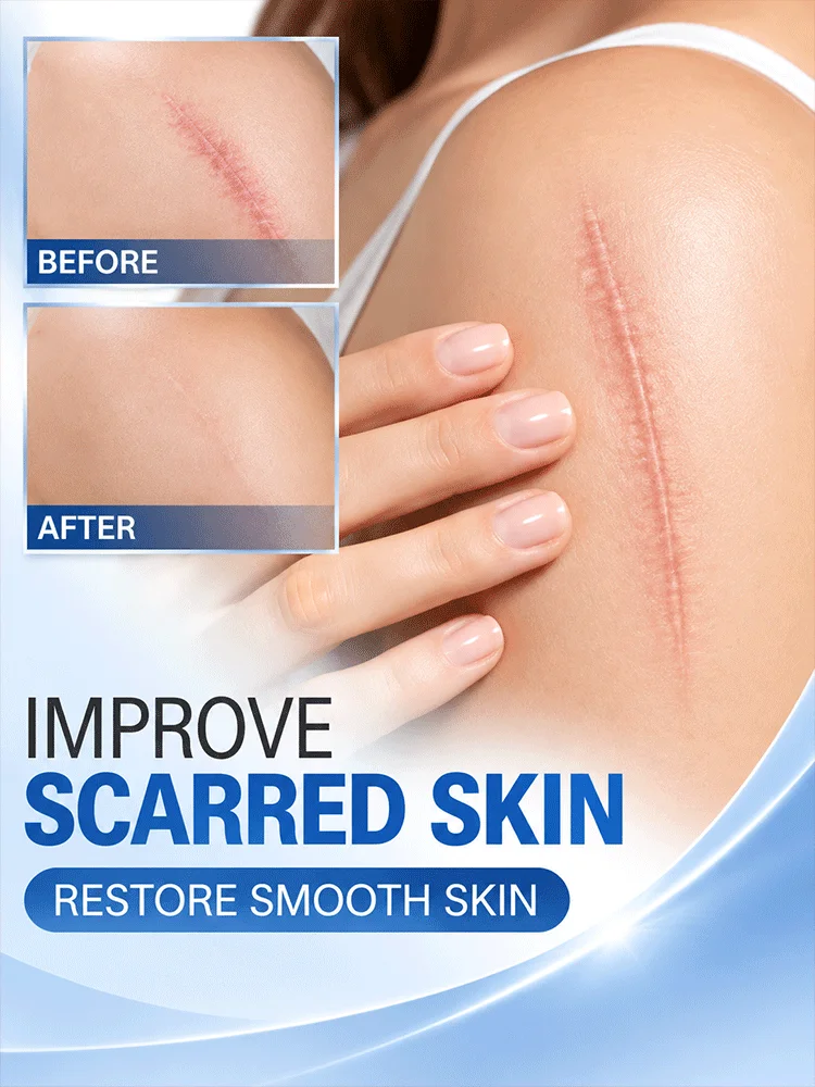 Silicone Scar Removal Cream Scar Treatment Stick Skin Repair Gel for Old Scars New Scars Face Body Care