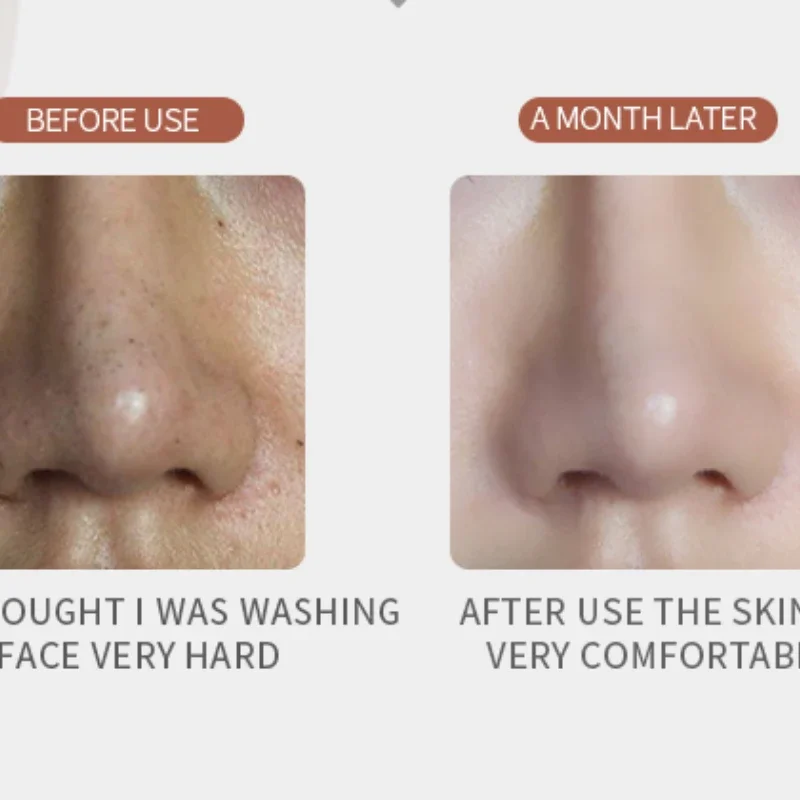 Remove edema, freckle, firm skin, refreshing and moisturizing, whiten, blacken, remove acne resist wrinkle, aging,tender skin