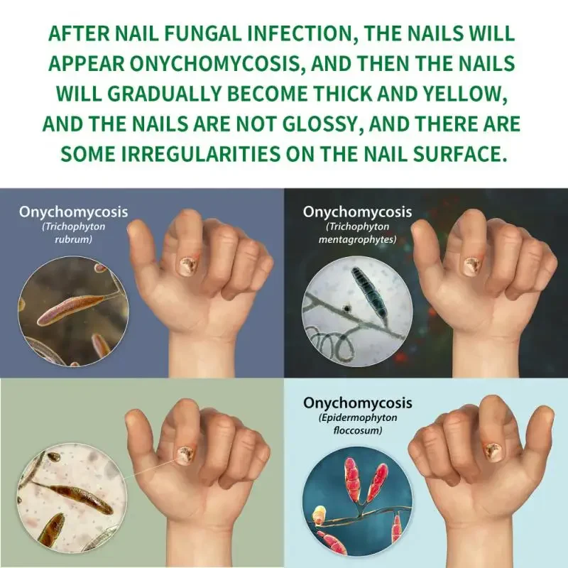 7 Days Nail Fungus Treatments Serum Foot Care Feet Care Essence Anti Infection Onychomycosis Foot Toe Nail Fungus Removal Gel