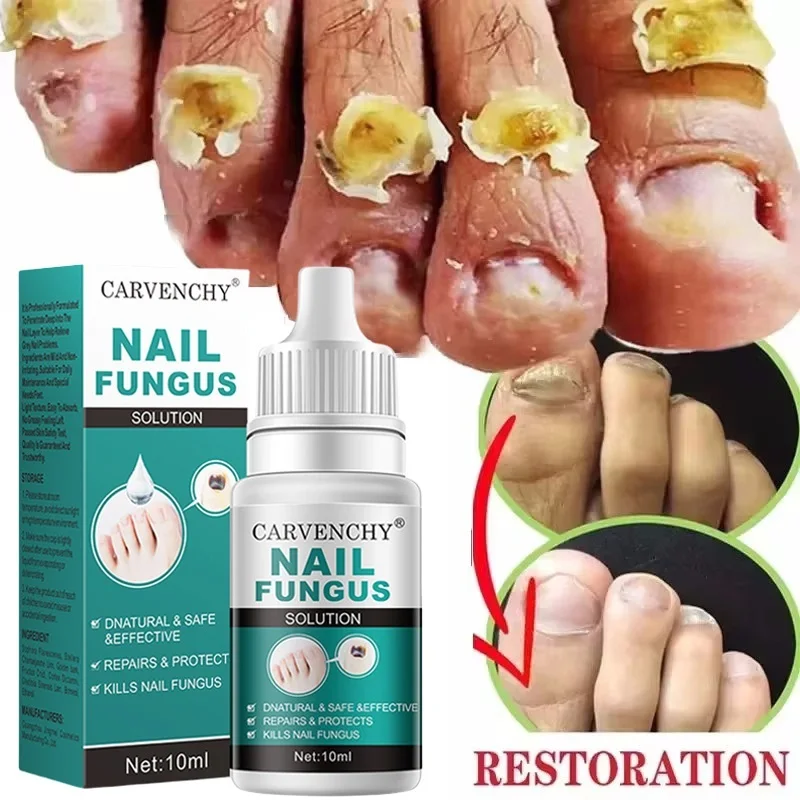 علاج الأظافر المضاد للعدوى ، المصل السائل ، مضاد للعدوى ، فطار الأظافر ، الداحس ، العناية باليد ، الأظافر والقدم ، جل إزالة الفطريات ، 10 * ، 7 أيام