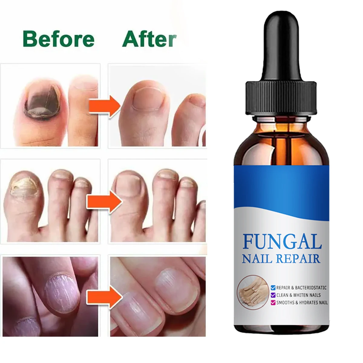 New Fungal Nail Treatment Foot Repair Essence Care Whitening Toe Nail Fungus Removal Gel Anti Infection