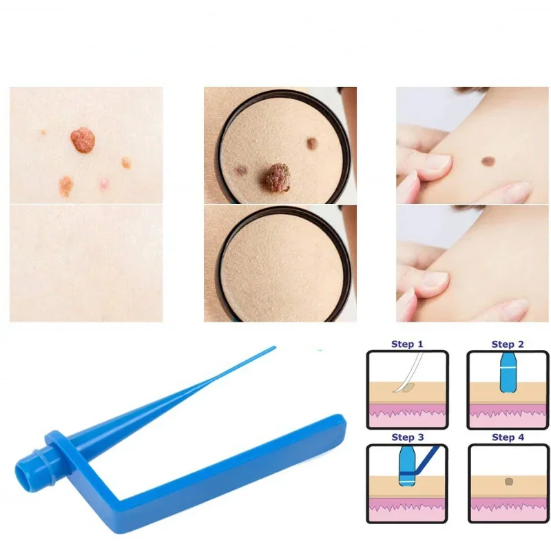 Skin Tag Removal Kit Skin Mole Wart Remover Micro Band  Removal Kit Skin Tag Treatment Tools Set With Cleansing Swabs