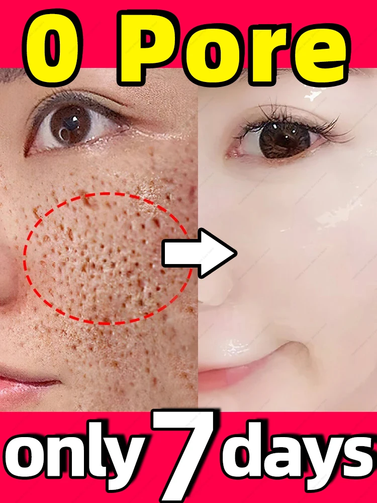 

Solves enlarge pores problem