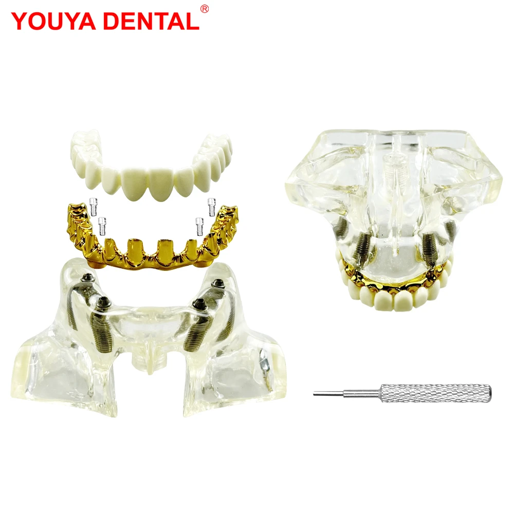 1pcs Dental Maxillary Sinus Lift Implant Model With 4 Implants Dentistry Upper Jaw Teeth Practice Training Restoration Models