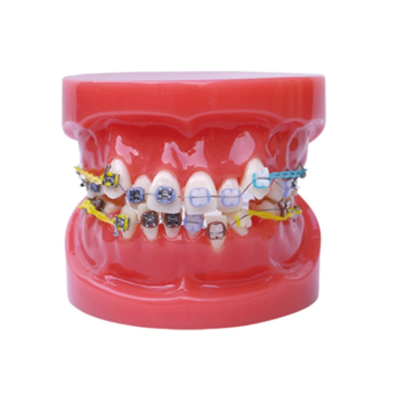 Dental Orthodontic Treatment Teeth Model Malocclusion Correction With Metal Brackets Teach Models for Patient Communication