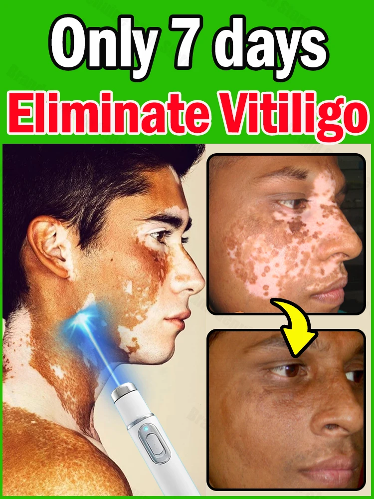 

Vitiligo- White Spots Blue Light Lase Technology