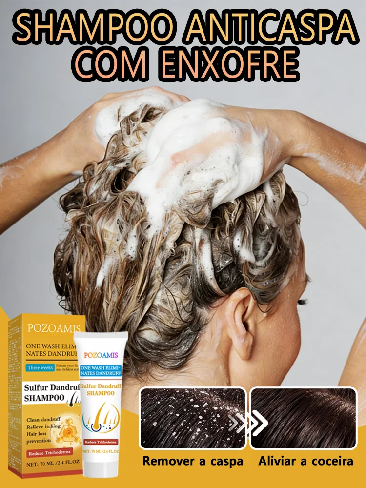 sulfur-shampoo-effectively-treats-stubborn-dandruff-and-deeply-cleanses-the-scalp