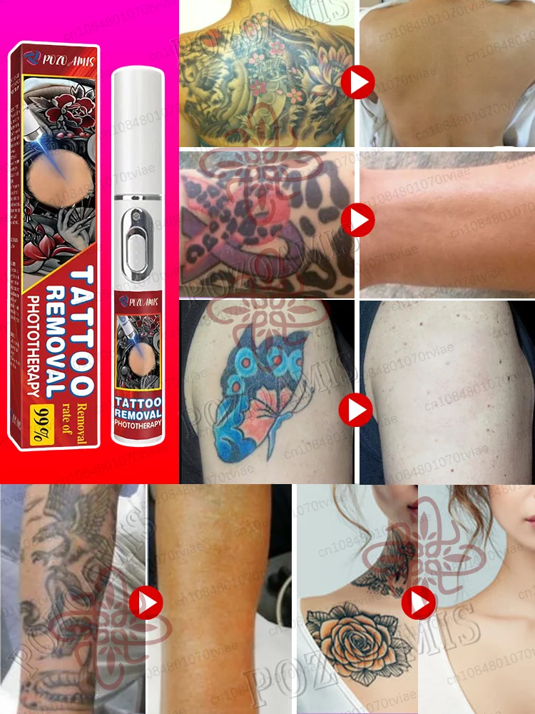 Deep cleaning of tattoos, decomposition of pigmentation, tattoo disappearance