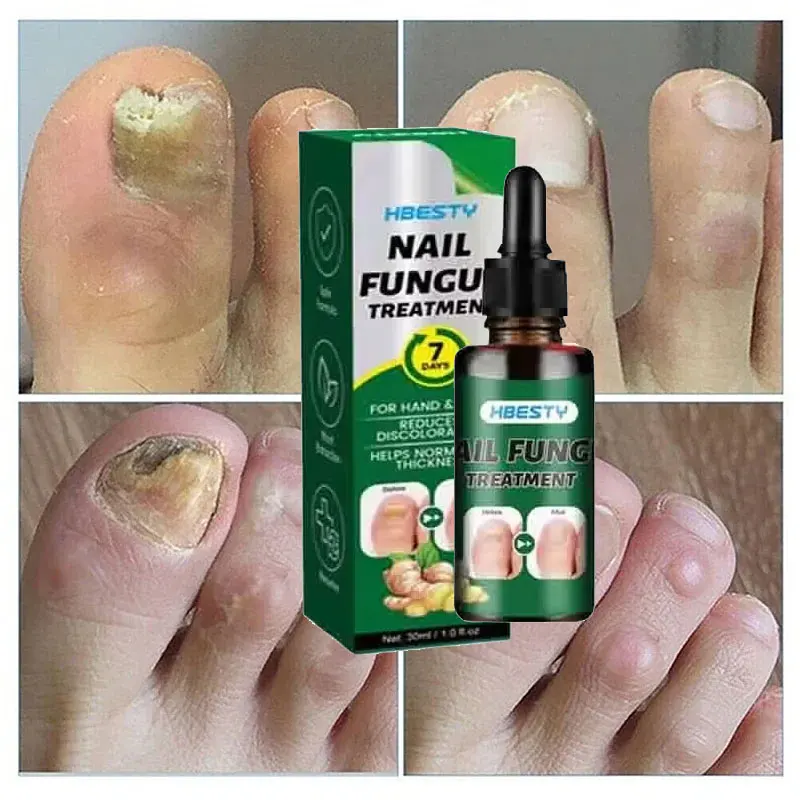 مسمار إزالة الفطريات مصل القدم تو مسمار الفطريات العلاج إصلاح زيت طبيعي مكافحة العدوى فطار الداحس العناية بالأظافر
