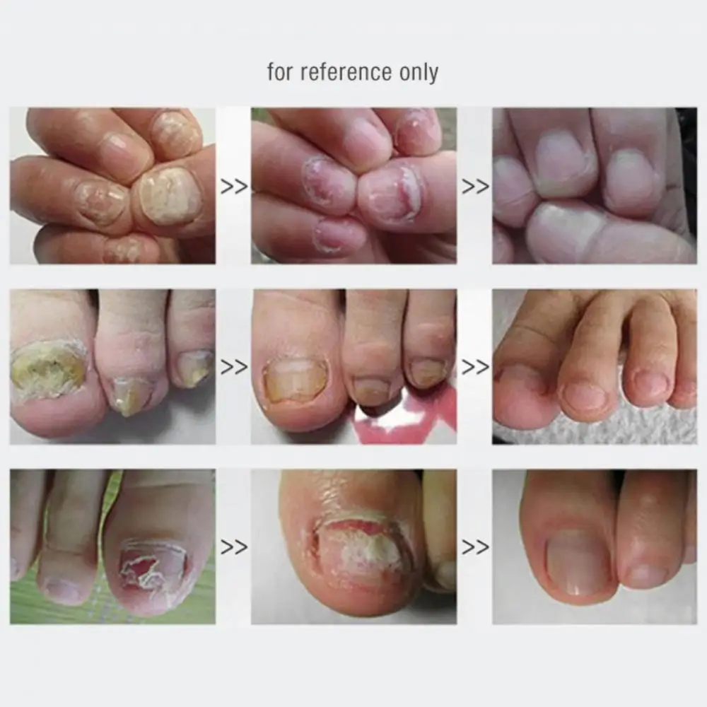 1/5PCS Onychomycosis Gel Visible Results Easy To Use Revolutionary Trending Advanced Popular Toenail Fungus Remover For Women