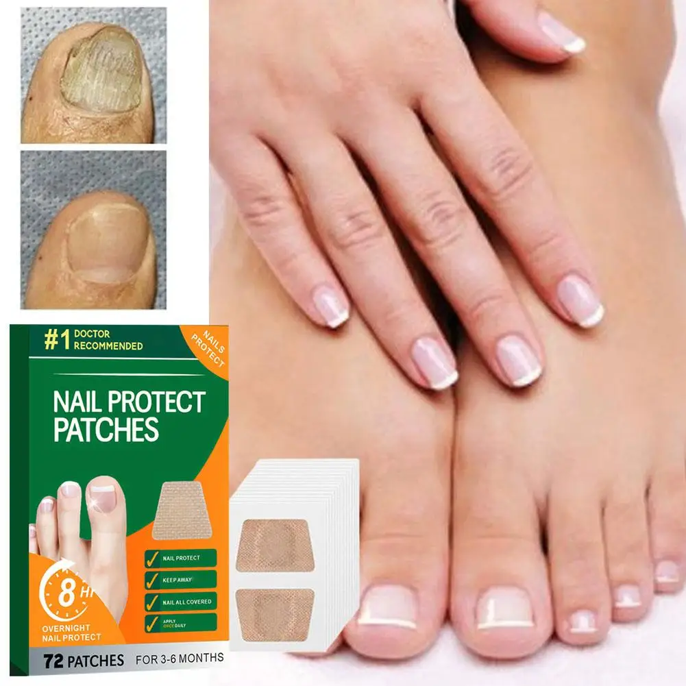 Remendo de reparo de unhas de pé cinza fungo prego engrossar infecção encravada adesivo macio paroníquia correção de mão unha