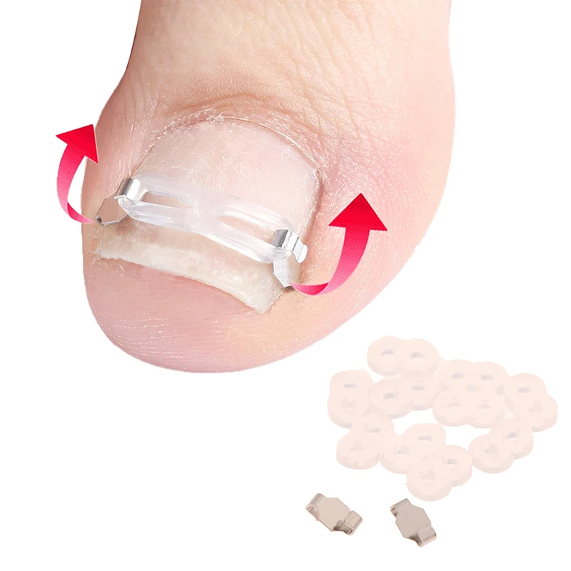 1 Set Ingrown Toenail Corrector Tools Pedicure Recover Embed Toenail Treatment Professional Foot Care Correction Tool