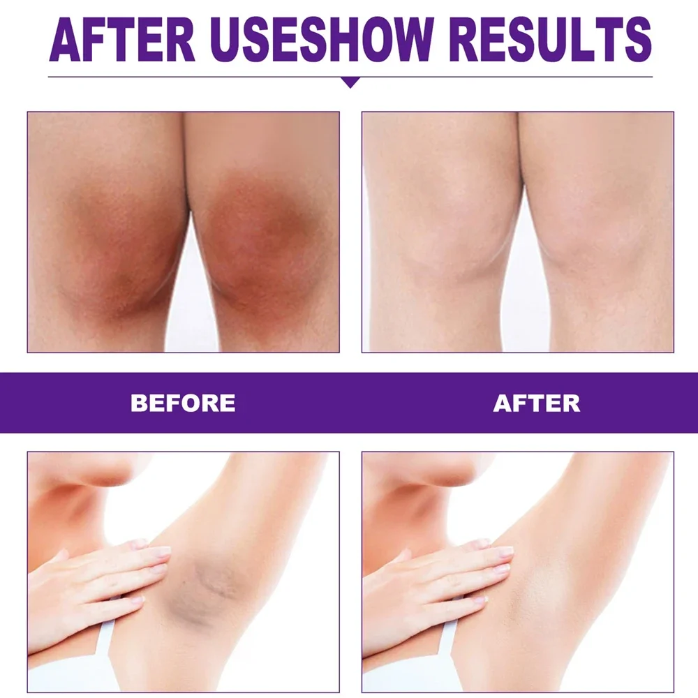 

Skin Whitening Cream for Dark Skin Lightening Private Parts Whitening Cream Arm Thigh Body Knees Whitening Brighten Skin Mild