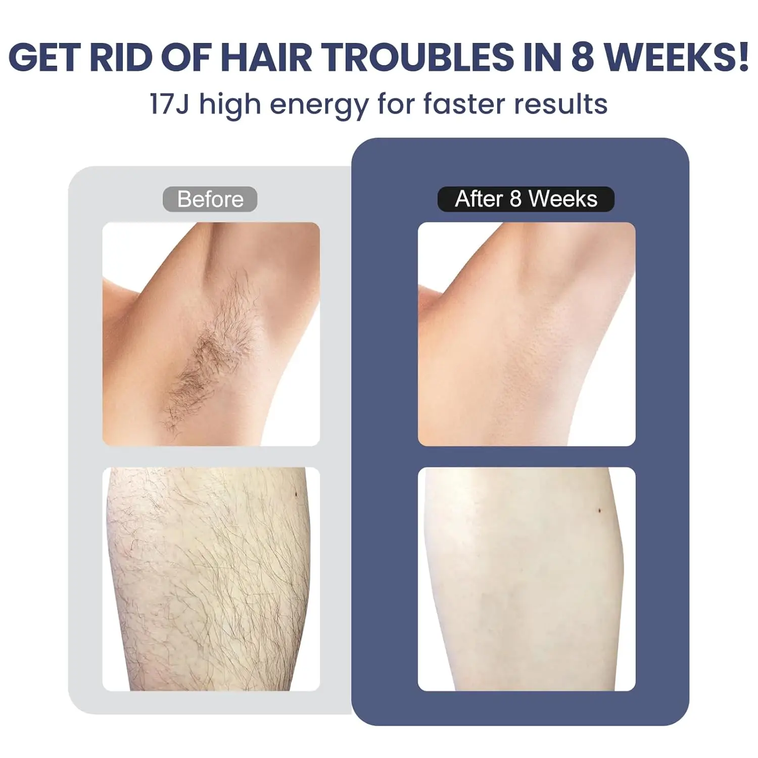 ماكينة إزالة الشعر بالليزر من الملايو T16، ماكينة إزالة الشعر الدائمة IPL، ماكينة إزالة الشعر بالليزر غير المؤلمة، ماكينة إزالة الشعر للرجال والنساء