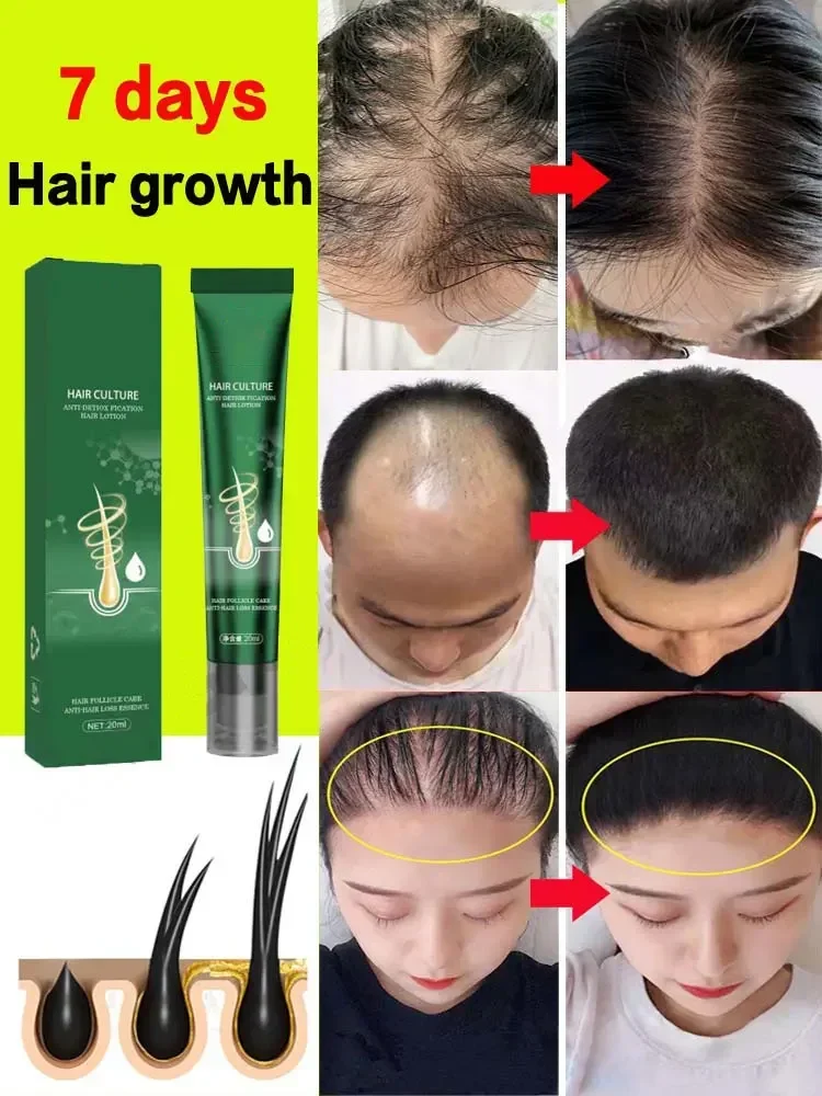 Produk penumbuh rambut, minyak penumbuh rambut cepat tumbuh efektif kebotakan esensial memperbaiki kemiringan Anti melahirkan