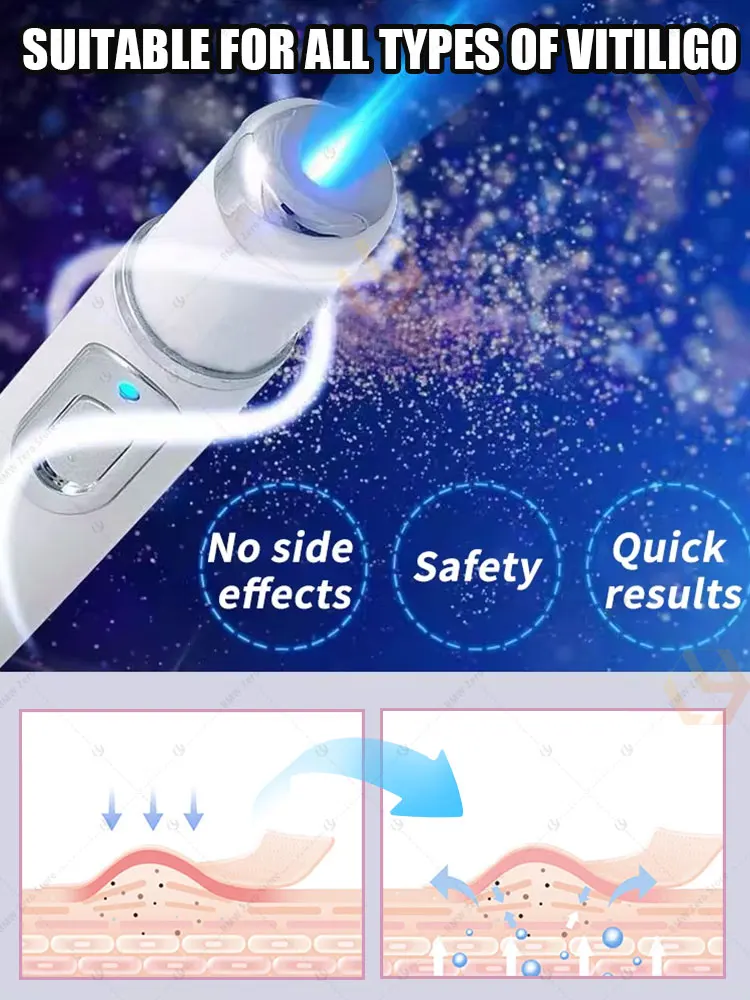 เทคโนโลยีเลเซอร์ใหม่ TR 2025 ช่วยปรับปรุงโรคด่างขาวได้อย่างมีประสิทธิภาพ
