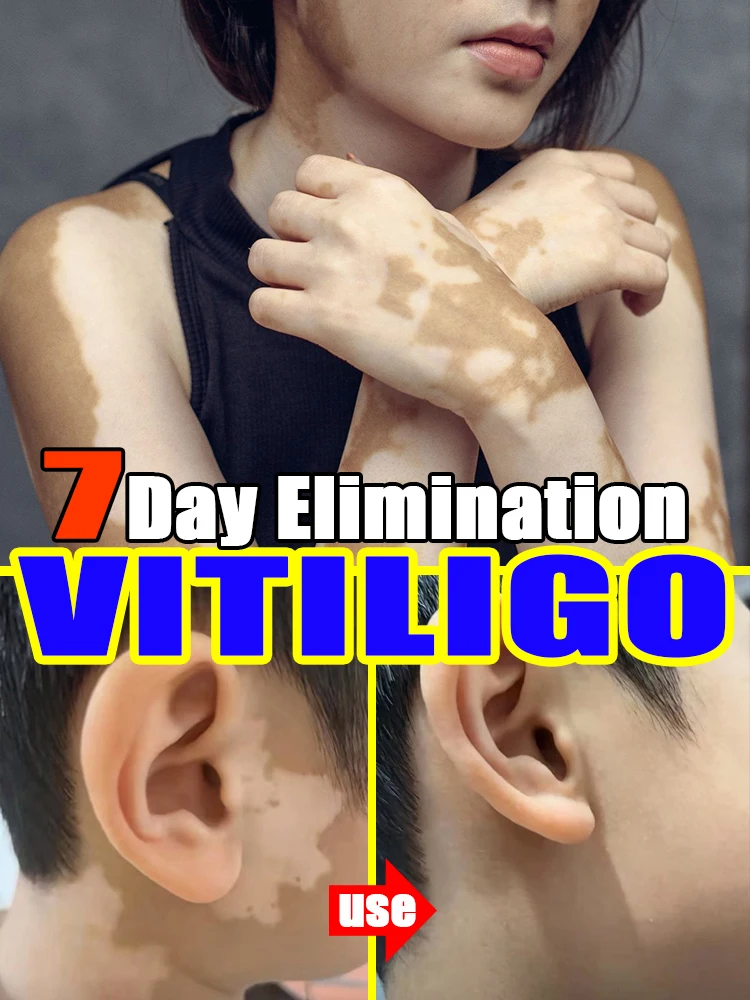 Effective treatment vitiligo cream desalination white spot products