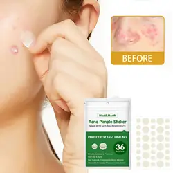 24/36Pcs Acne Pimple Patch Sticker Acne Treatment Pimple Remover Skin Facial Care Для Mask Tool Blemish Лица Spot Маска