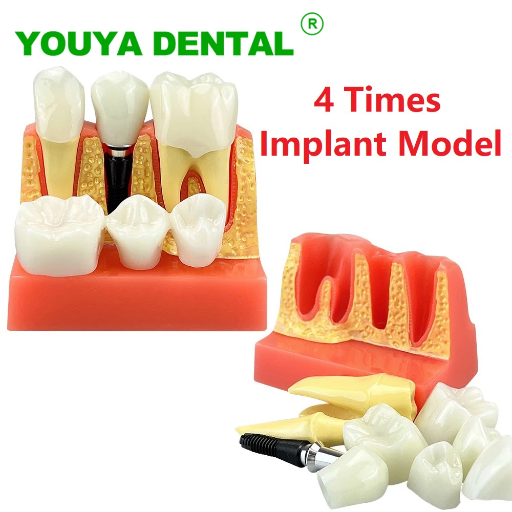 Dental Implant Model 4 Times Implant Analysis Crown Bridge Removable Model Dentistry Demonstration Teeth Study Teaching Model