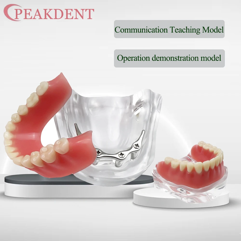 

С 4-имплантатами, модель для восстановления зубного протеза, нижняя щелепа M6008, модель зубов с серебряным стержнем для обучения, демонстрационная модель Typodont