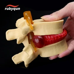 Human Adult Anatomical Spine Lumbar Disc Herniation Model Medical Teaching Learning Aid Anatomy Instrume Skeleton Tools DIY