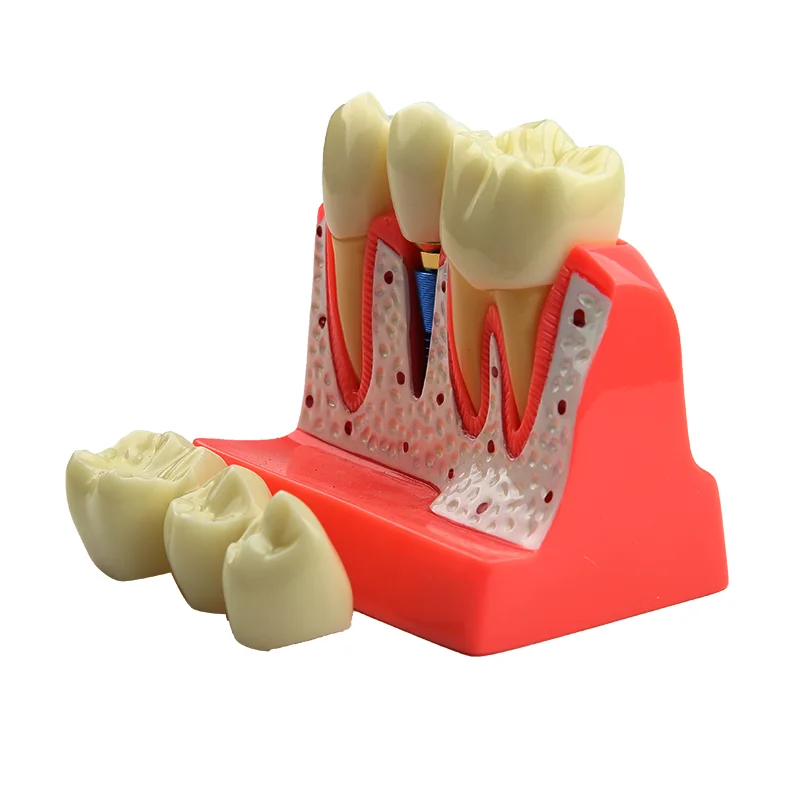 Dental Model Dental Implant Model Denture Bridge Crown Porcelain Restoration Model Dentist Teaching Demonstration Models