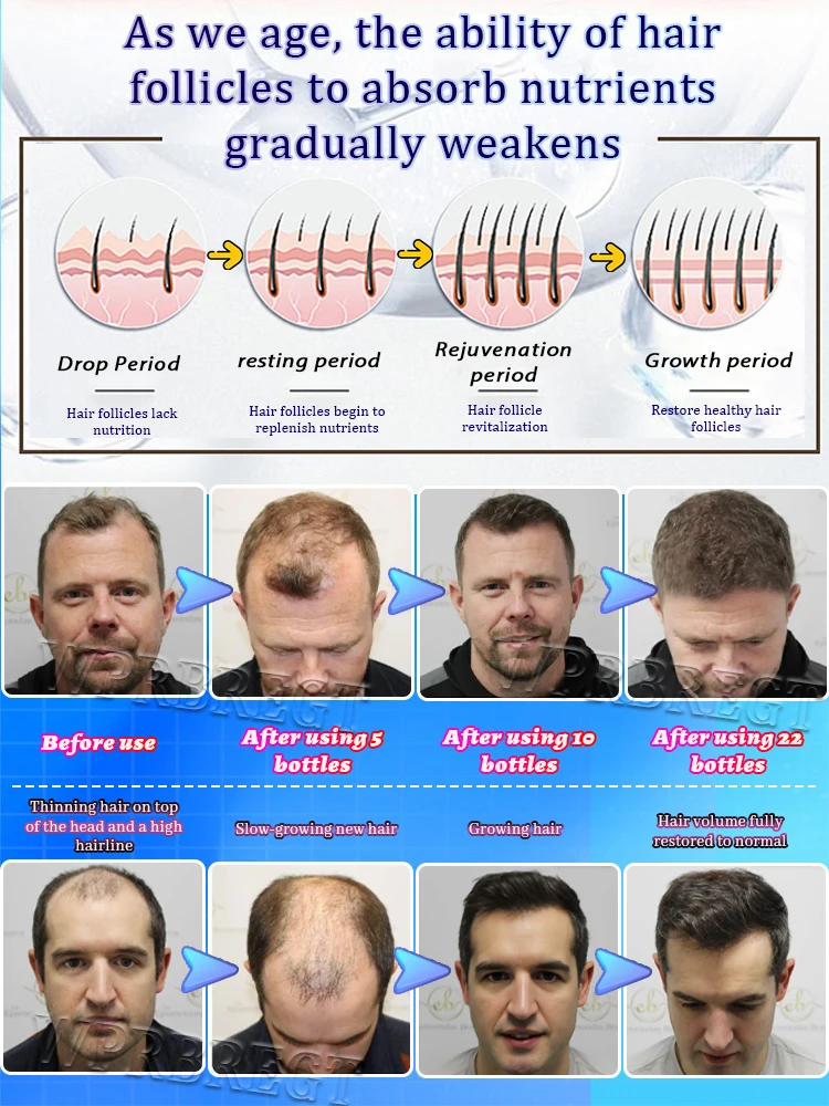 تركيبة مغذية جديدة للجذور لزيادة حجم الشعر 10 سم