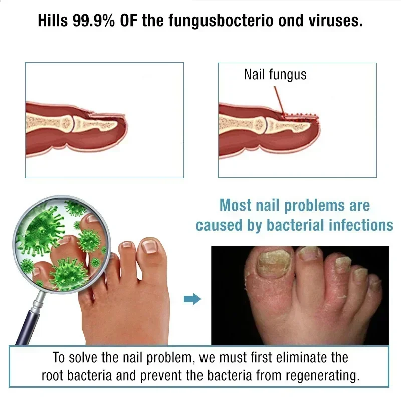 NewNail-suero para tratamiento de hongos, Gel líquido para reparación de pies, eliminación de hongos en las uñas de los pies, antiinfección, paroniquia, onicomicosis, Oil0903