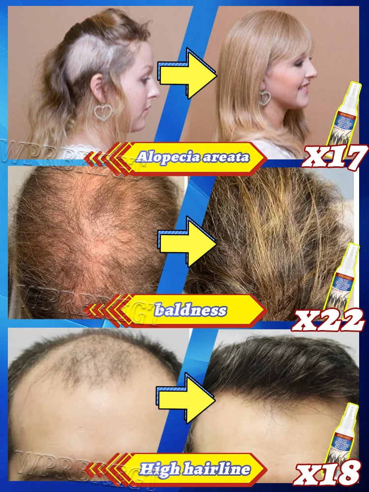 تركيبة مغذية جديدة للجذور لزيادة حجم الشعر 10 سم