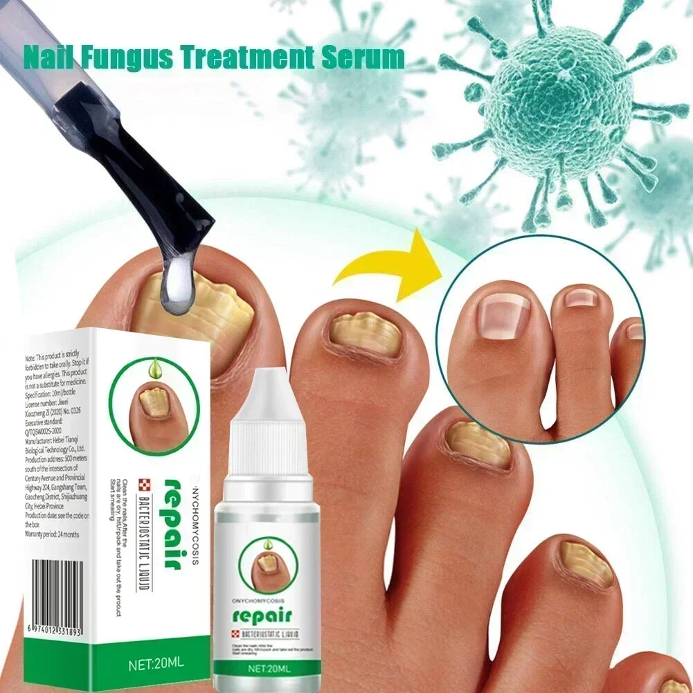 ²⁰²⁵ Effective for 7 days Onychomycosis Nail liquid comes swab to remove onychomycosis