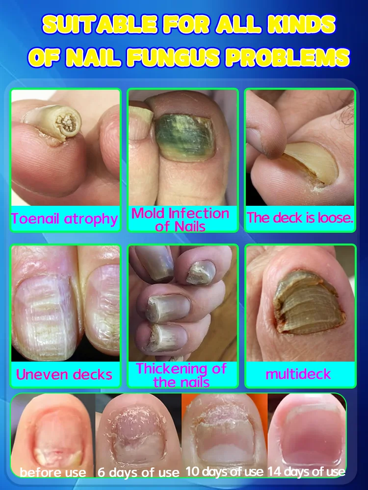 Les ongles deviennent sains et lisses sans avoir à se soucier des mycoses.