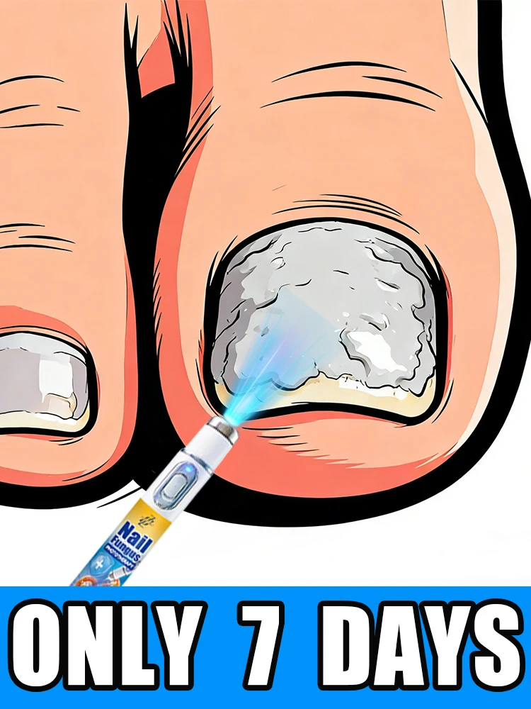 

2026Nᵃⁱˡ Fᵘⁿᵍᵘˢ Tʳᵉᵃᵗᵐᵉⁿᵗ,Oⁿʸᶜʰᵒᵐʸᶜᵒˢⁱˢ