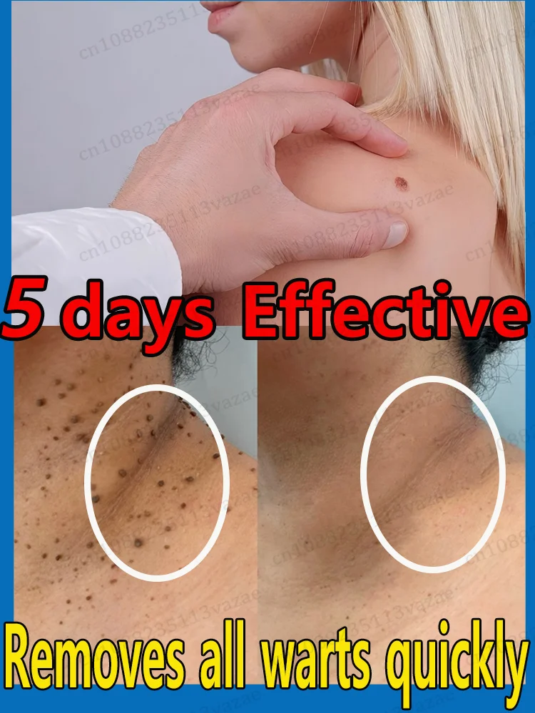 

Verwijder alle Soorten wratten en포 uw Pangerlage рад