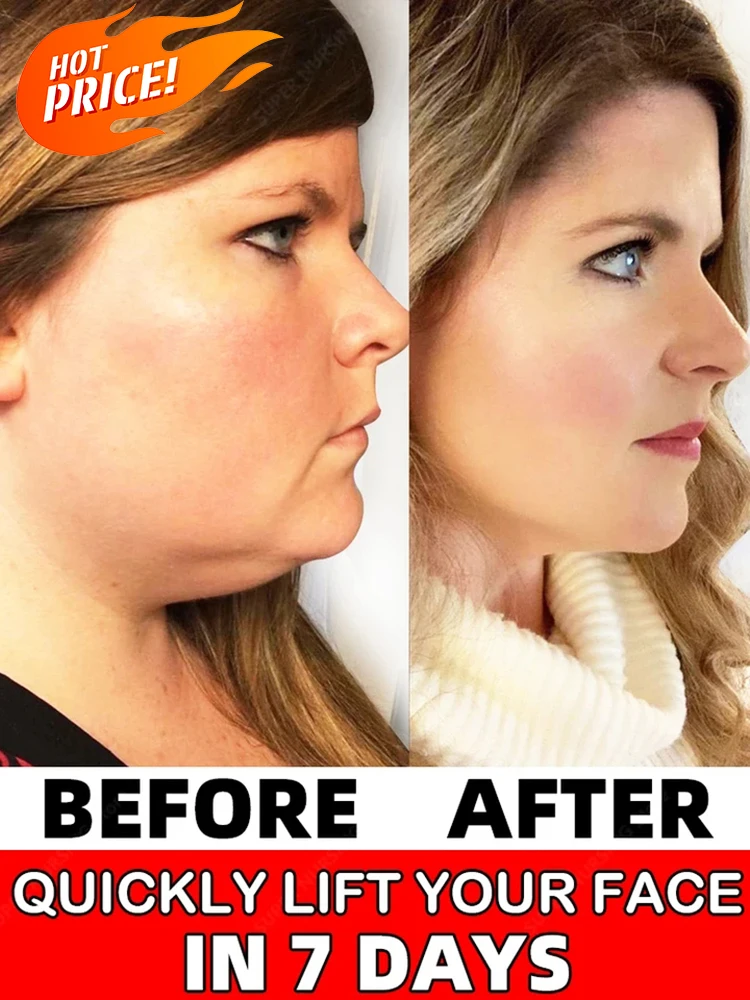 

Remove double chin v lifting