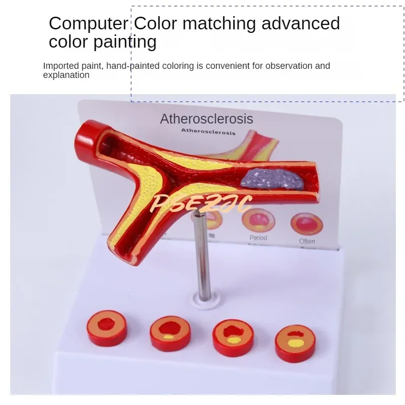 PVC Coronary Cardiovascular Model Sclerosis Elderly Heart  Vascular  Medical Teaching Supplies