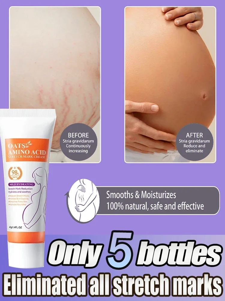 Scar Stretch Marks Cream Repair cream Removal Acne Scar Stretch Marks Cream Fat Scar Striae Treatment Body Creams