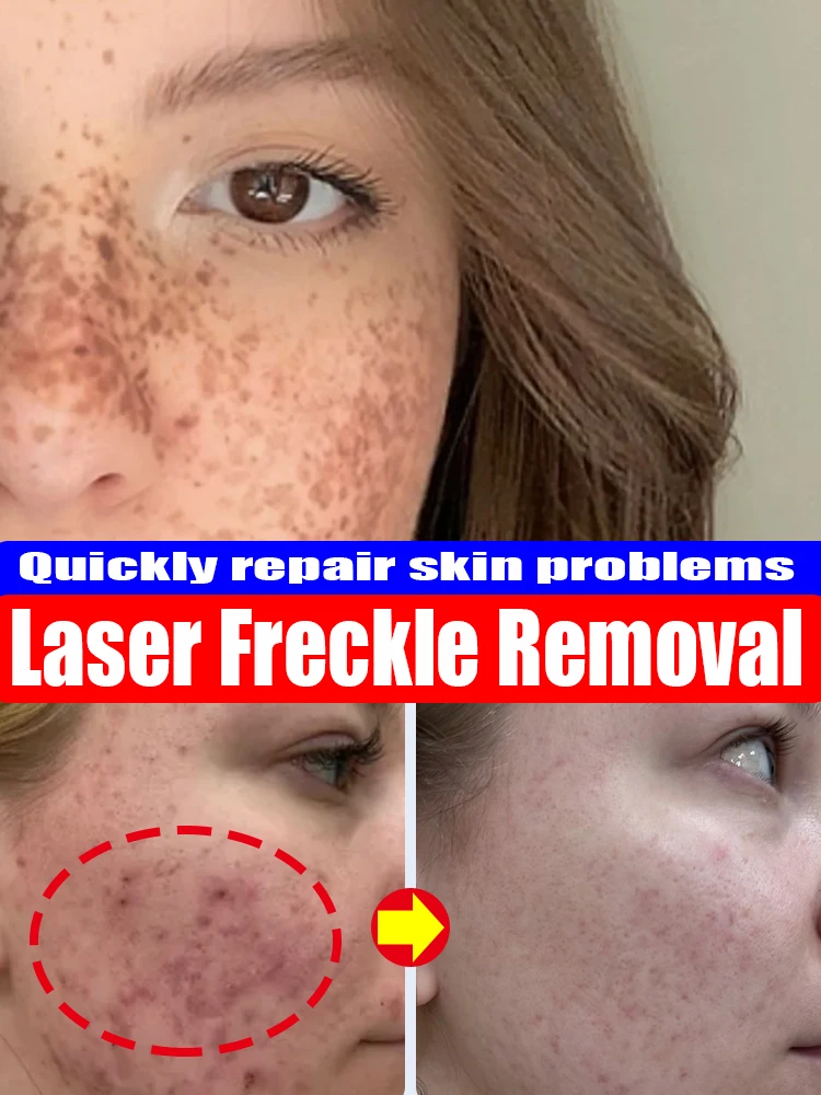 

Laser Spot Cream