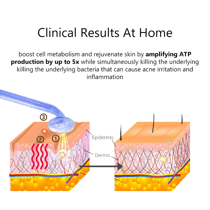 DARSONVAL-aparato Facial de alta frecuencia para vello Facial, herramienta de terapia antienvejecimiento para el acné, fusión de neón + varitas de