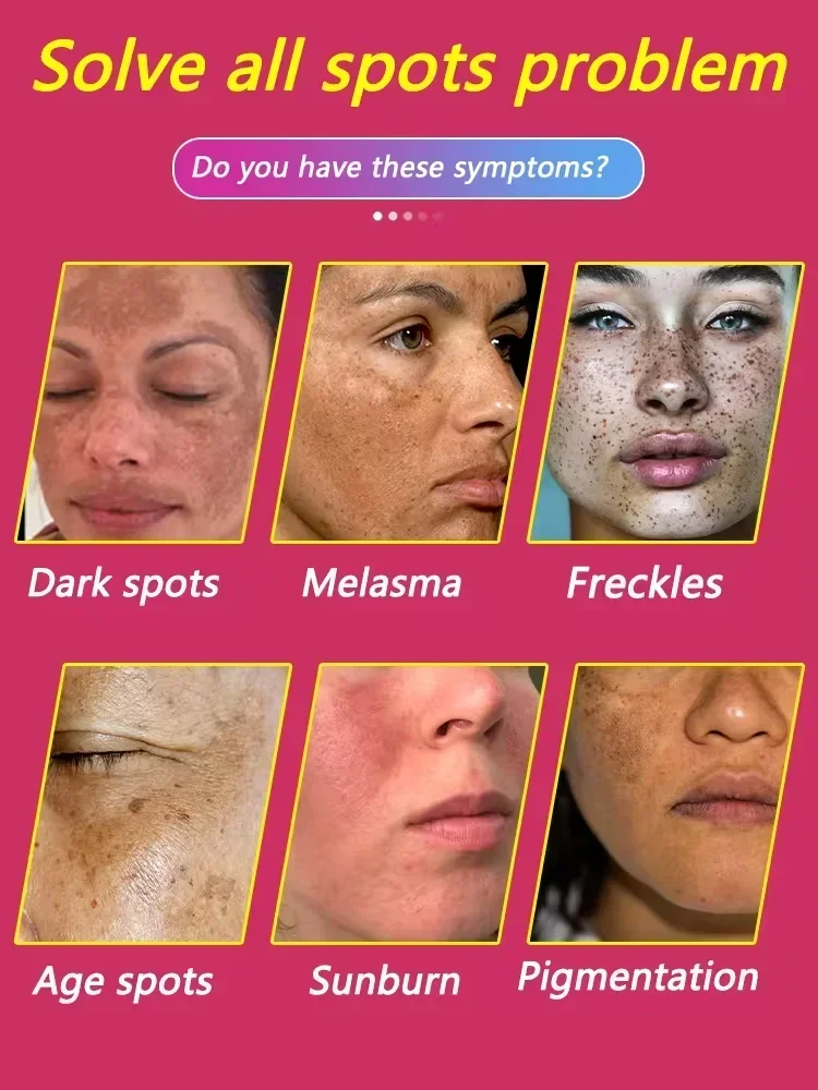 Freckles Melasma Melasma Dark Spots on Face Laser Pointer