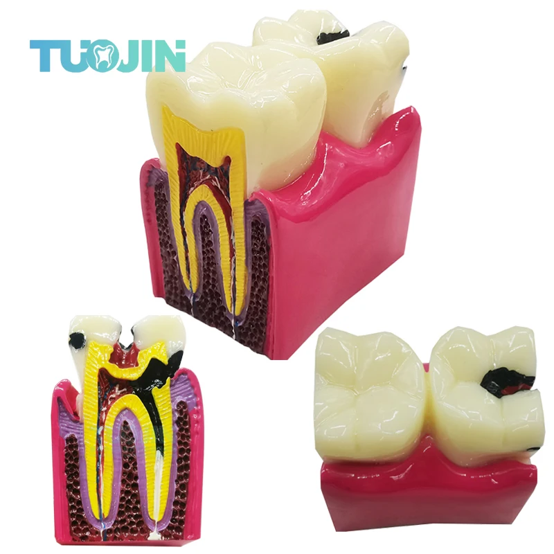 

6-кратная модель кариеса, заболевания зубов, стоматологическая модель для стоматологической демонстрации, модель стоматолога, обучение, стоматологическая лаборатория, исследование полости рта