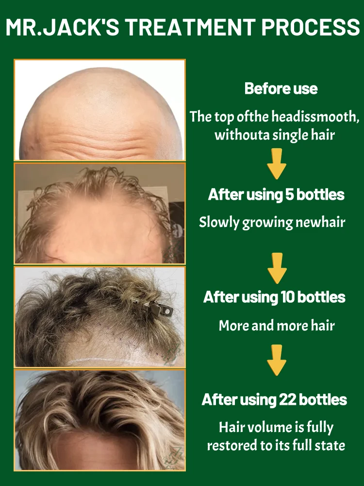 Thick hair is easy, say goodbye to baIdness, hair growth essence oiI