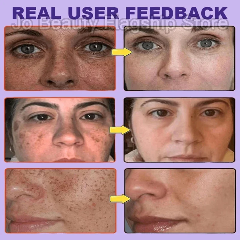 Siero di vitamina B3 Dissolvenza Macchia scura Cloasma Schiarire la melanina Pigmentazione Pori lisci Ringiovanimento Schiarente Essenza idratante