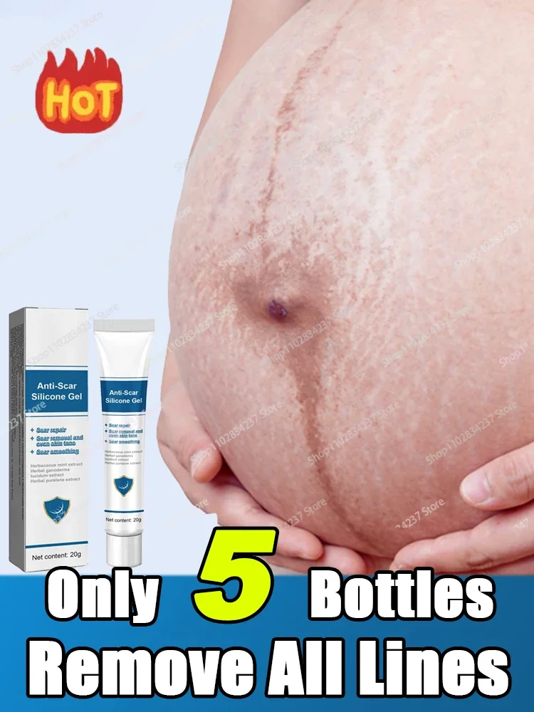 Eliminate Red White Old Stretch Marks For Pregnancy Stretch Marks Removal Product