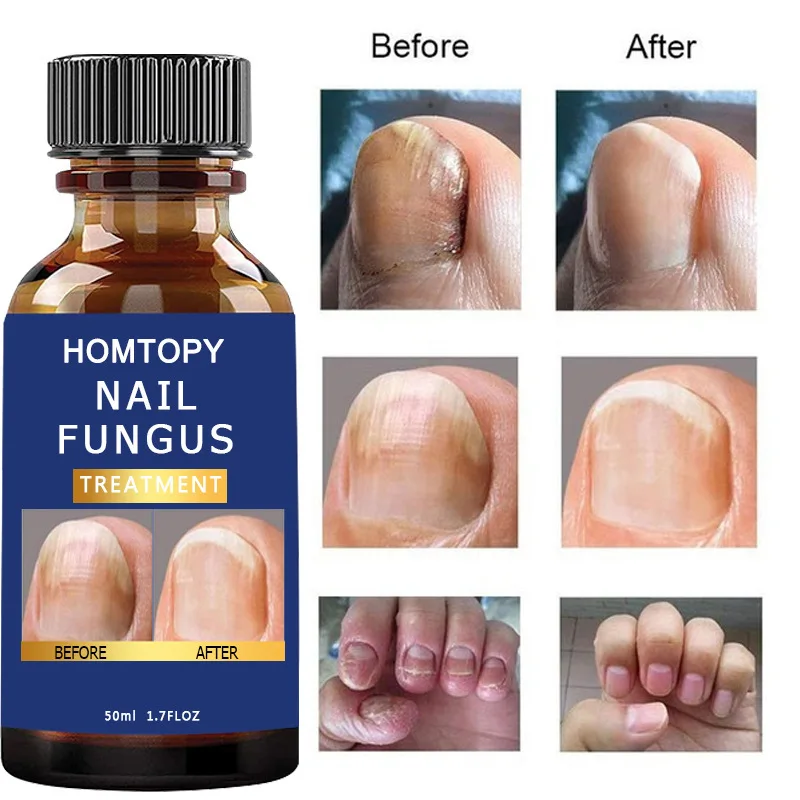 Nail Fungus Treatment Oil Feet Nails Repair Extra Strong Care Essence Anti Infection Paronychia Toe Fungal Removal Essence 50ml