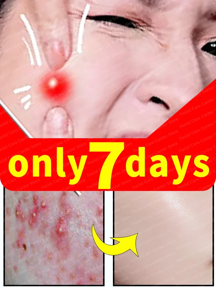 

remove acne scars face marks remedy pimple remedy