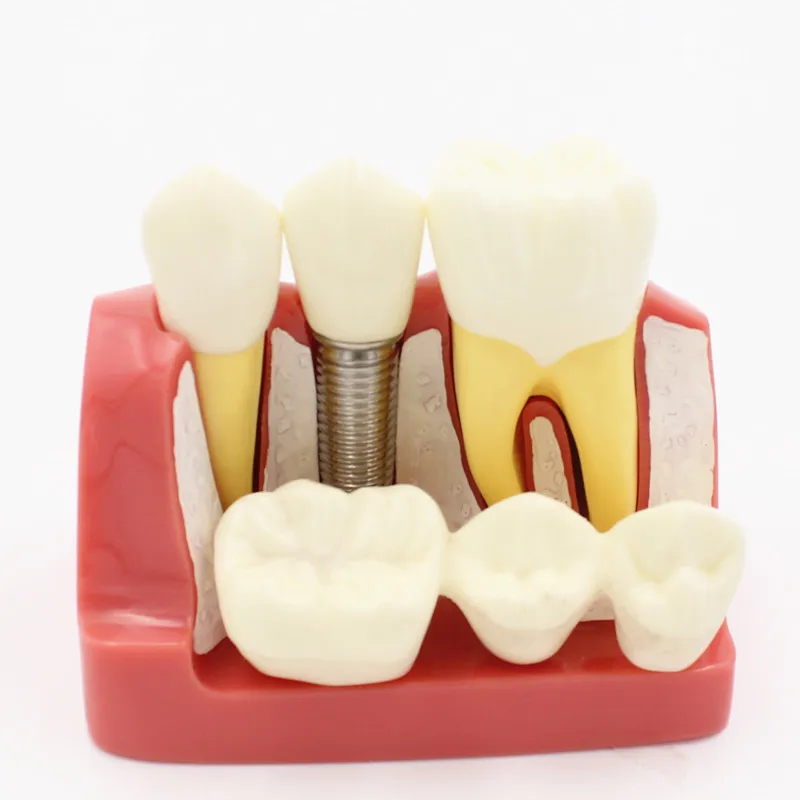 Dental 4 times planting Teeth model Analysis Crown Bridge Removable Model Dental Demonstration Teeth Model