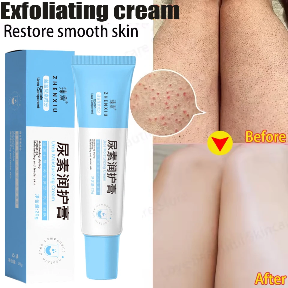 New Chicken Skin Repair Cream Curing Keratosis Follicle Pilaris Remove Thick Pores Body Dark Spot Moisturize Smooth Skin Care