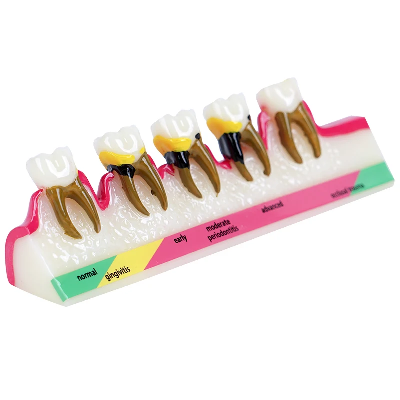 1pc Periodontal Disease Model 5-Stage Perio Disease Assort Demo Caries Periodontitis Dental Teeth Model