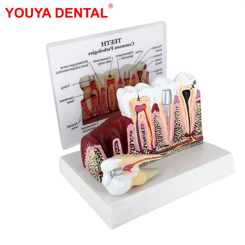 Fully Anatomical Teeth Model For Studying Teaching Demonstration Dentist Dental Models For Patient Education Dentistry Products