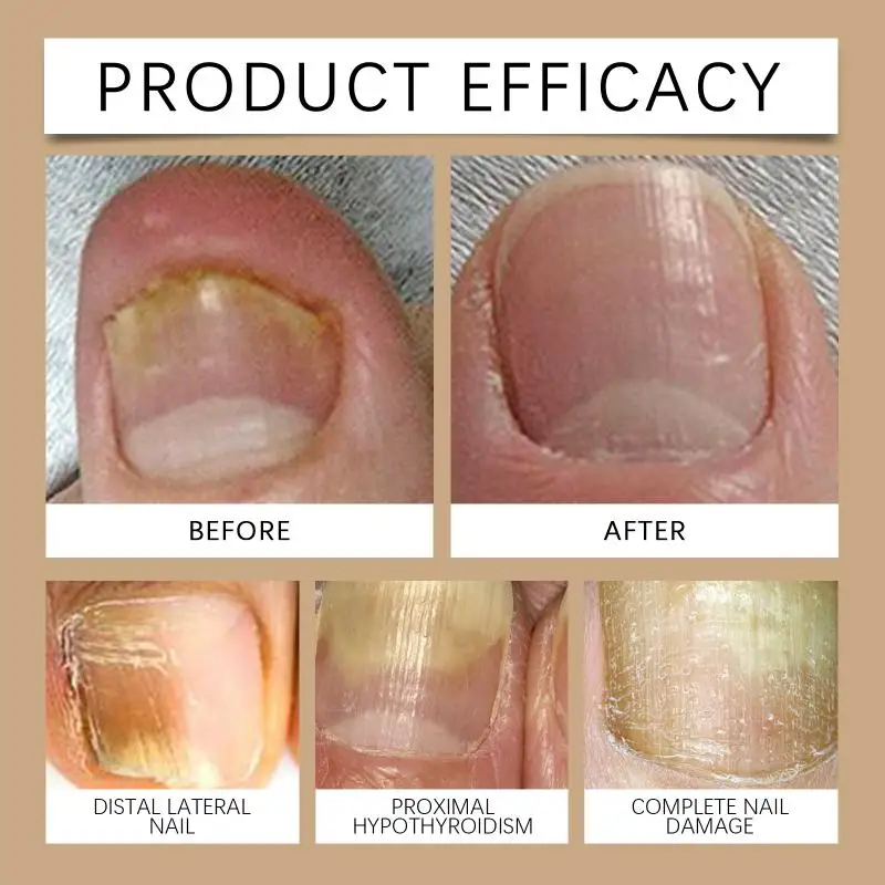 HOT！Foot Spray Anti Smell Remove Toenail Fungal Paronychia Onychomycosis Care Deodorant Antiperspirant Nail Repair Spray